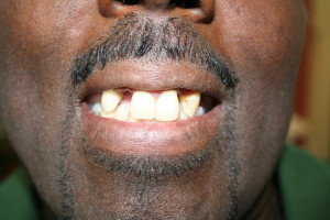 BEFORE CROWNS AND PARTIAL DENTURE