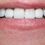 EXISTING OLD CROWNS WITH GUMS SHOWING