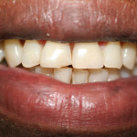 BEFORE, CHIPPED TOOTH REPAIRED PREVIOUSLY