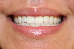 T1 after invisalign