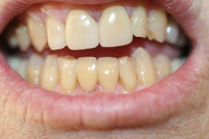 ZA42 after lower crowns