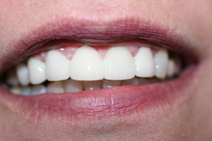 ZA43 after veneers replaced