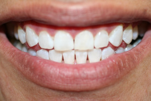 ZA46 after invisalign close space and whitening