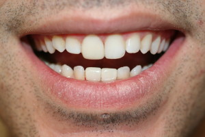 ZA57 after crowns and veneer