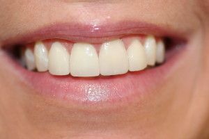 I1I after cosmetic crowns
