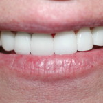 NEW CROWNS AND VENEERS WITH LASER GUM LIFTING