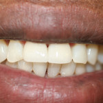 AFTER, CROWN PALCED TWO FRONT TEETH