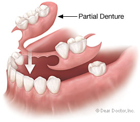 partial-denture2