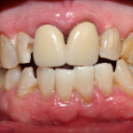 old crowns and cavities