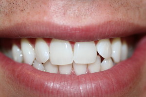 J1 whitening after
