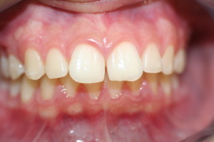 L before invisalign, space between teeth
