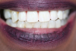 ZA08 after parial upper denture and periodontal therapy