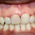  before veneer discolored tooth