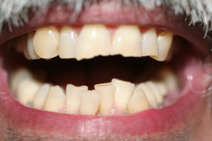 ZA39 before six month braces and crowns