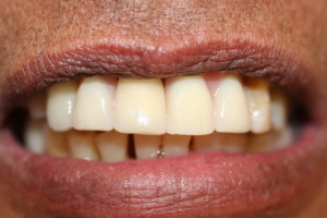 ZA55 after new partial upper denture