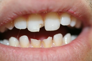 ZA56 before chipped teeth