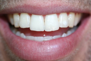 chase after invisalign and whitening 2