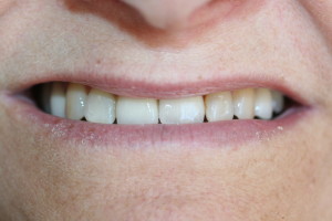 after implant front tooth