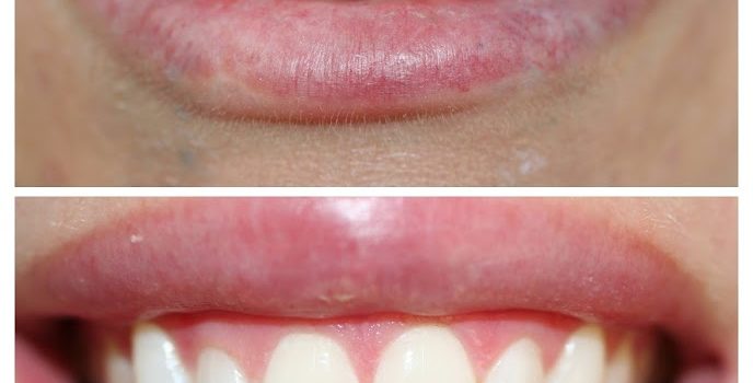 VENEERS TO REPLACE CROWDED AND SHIFTED TEETH